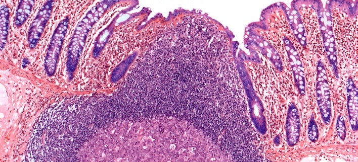 Inflammatory Bowel Disease