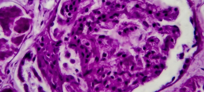 Lupus Nephritis