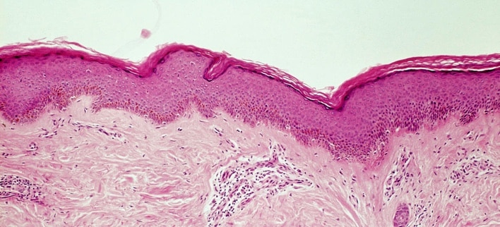 Systemic Sclerosis