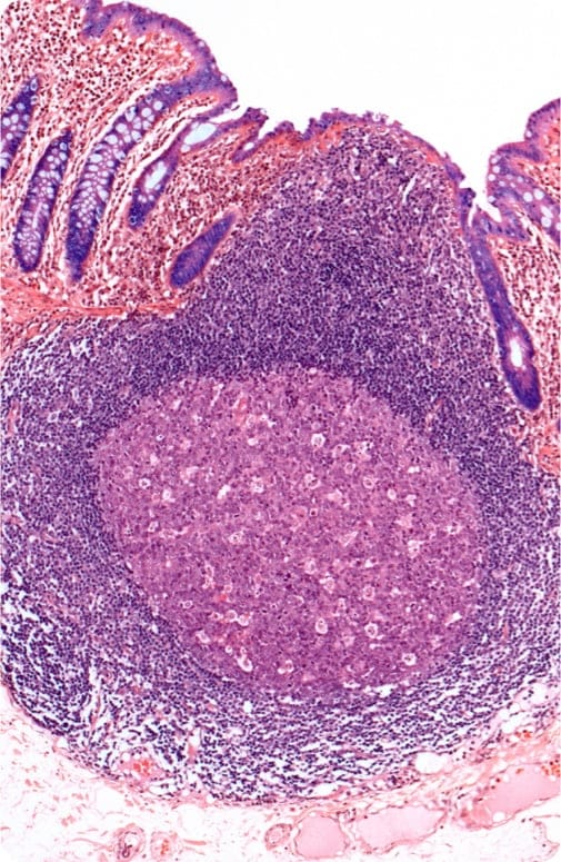 Inflammatory Bowel Disease